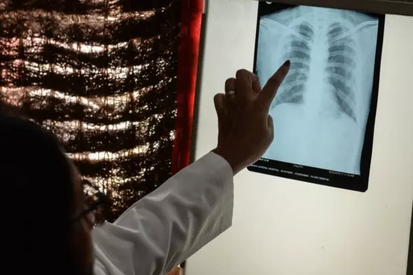 A doctor checks the chest X-ray of a patient in the tuberculosis (TB) department of a hospital in Hyderabad, India. COVID-19 has directed some resources away from tuberculosis-related care, which has had devastating impacts on populations at risk. PHOTO BY NOAH SEELAM /AFP VIA GETTY IMAGES